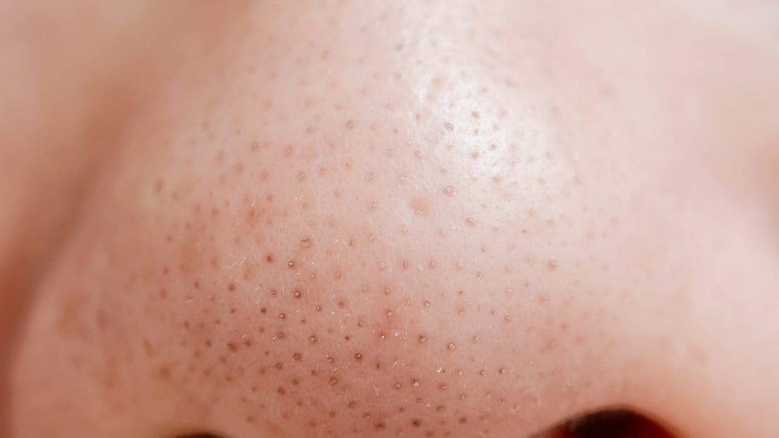 Zewan and Blackheads: Causes, Types, and Treatment Methods