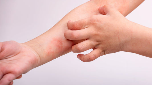 Eczema: Causes, Treatments, and Prevention for a More Comfortable Daily Life