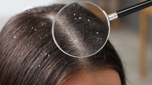 Top Ingredients for Treating Dandruff